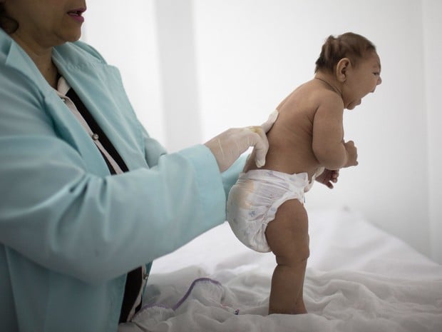 zika birth defects felipe dana ap - Pragas e Eventos