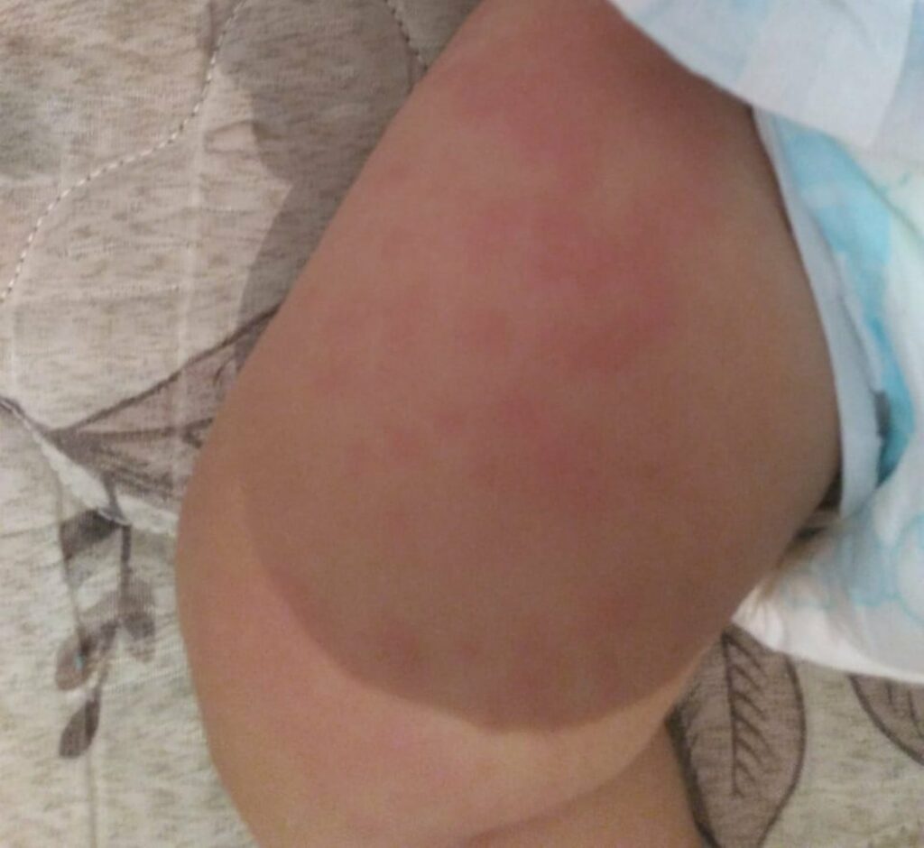 Bebê diagnosticada com leishmaniose em Matão apresentou manchas na pele e muita febre — Foto: Arquivo pessoal