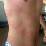 Percevejos em Alojamentos Militares de Cascavel: Alerta