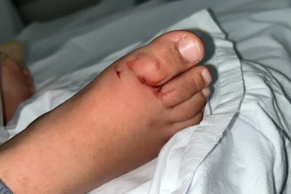 duas criancas sao picadas por escorpiao em menos de uma semana em creche - Pragas e Eventos
